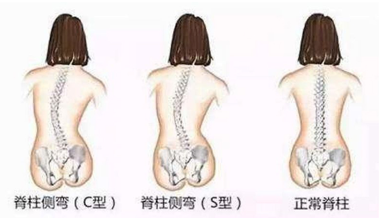 我国青少年患脊柱侧弯的几率高达5.4%